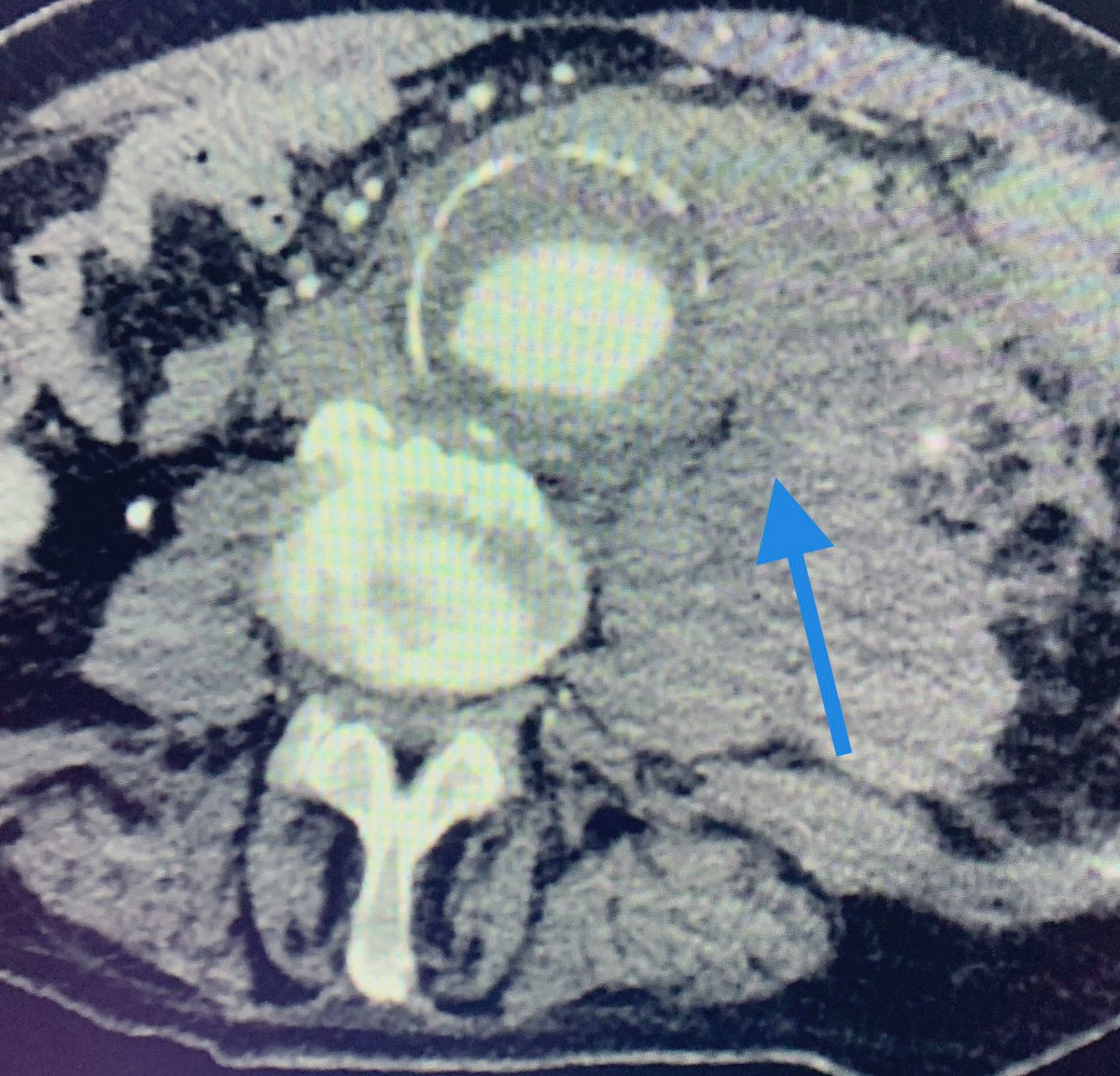 t_intheleadcoat's tweet photo. Ruptured infrarenal AAA, 68 y/0 M, BP stable , occluded L CIA but patent b/l CFA. Decent proximal neck 2 cm long, 29 mm. If EVAR pursued, curious about treatment plan? Uni with fem-fem or attempt cross CIA and use bifurcated device in a stable patient. #EVAR #rupturedAAA #irad https://t.co/1hoDDYtg76