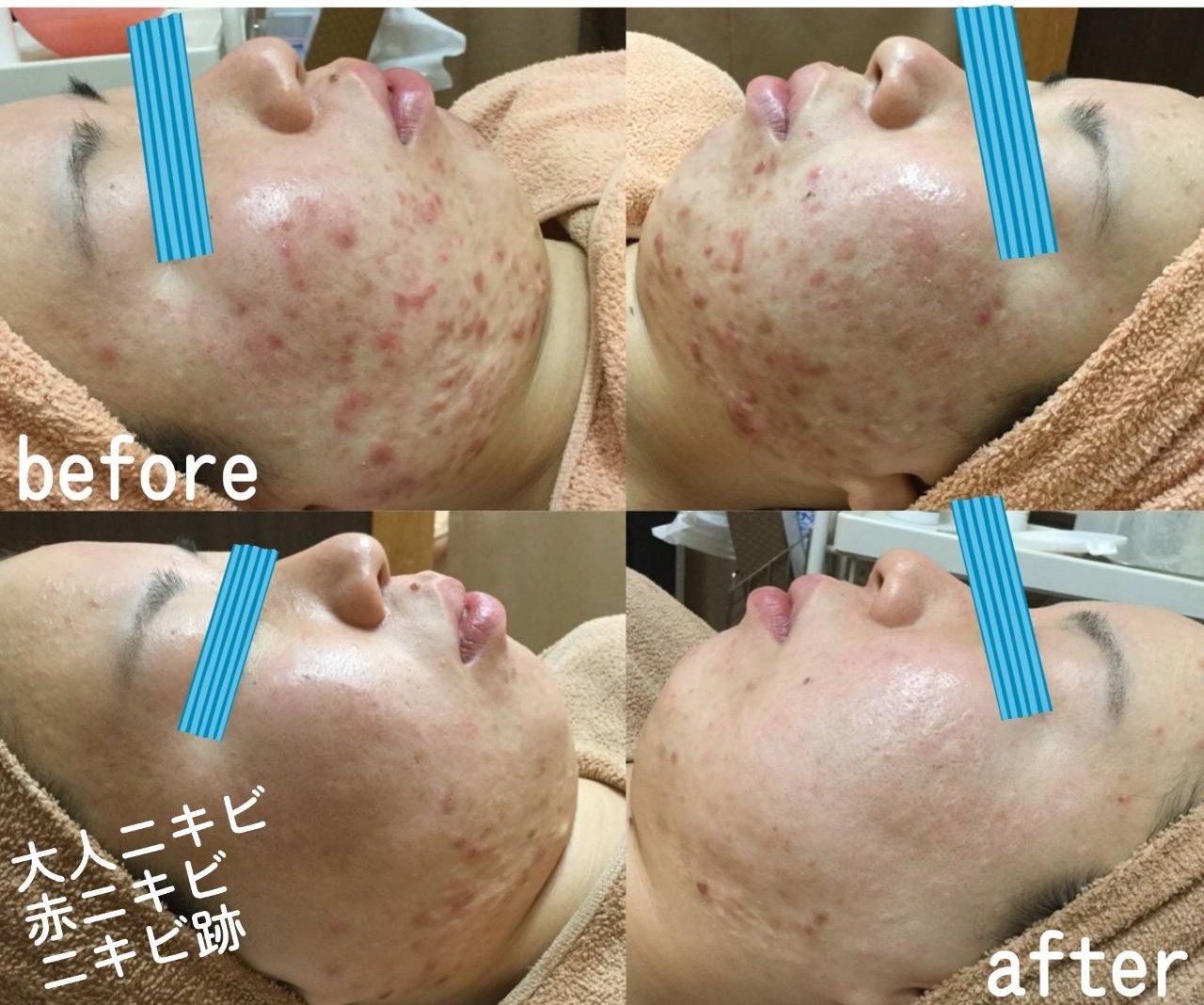 医療提携サロンritz リッツ 頑固な赤ニキビ 大人ニキビ 跡になっていても大丈夫 繰り返しの肌荒れを根絶します T Co Irvktaqh0d Twitter