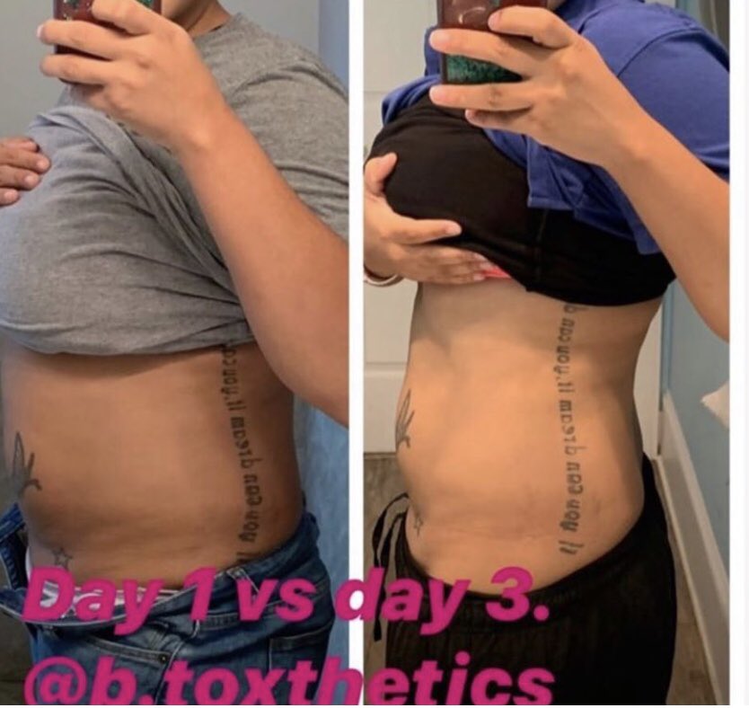 BToxthetics's tweet image. Good Morning @BToxthetics Kings and Queens!! #BookingsAvailable #ATL #Lipo #Motivation #nurselife #Botox #WeightLoss #hustlehard #Miami I’m still working waiting on you to wake up and book your free consultation 😉👩🏾‍⚕️💅🏼🤳🏾