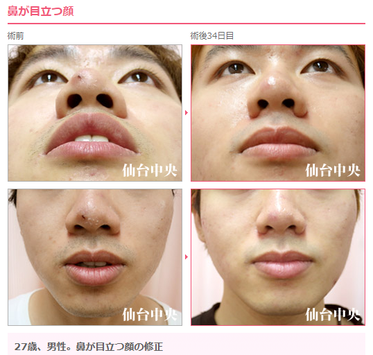 仙台中央クリニック美容整形美容外科 V Twitter 鼻が大きい 鼻が目立つ 症例に 鼻縮小 をしました 小鼻 が 横に広がる鼻 は間が抜けて見えます 鼻孔内からの切開で 鼻の横幅 を狭めて鼻を縮小させることが出来ます 出血や細菌感染のリスクが知られています