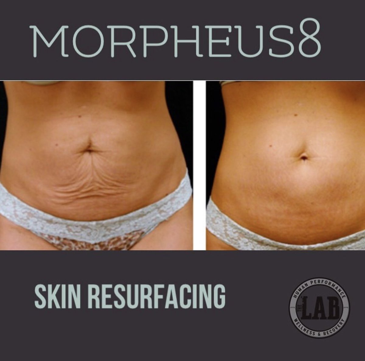 TheLabPRC's tweet image. #Morpheus8 has been proven to stimulate the production of #collagen, tighten #skin, fade stretch marks and minimize scars from acne or surgery.  Purchase any 3 pack of Morpheus8 sessions and we’ll give you 20 units of #Botox for free!