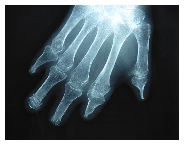 NEJM's tweet photo. From the #NEJMArchive: Systemic Sclerosis and Acral Osteolysis https://t.co/sDbCdSlRjn https://t.co/Re2GGrNuy2