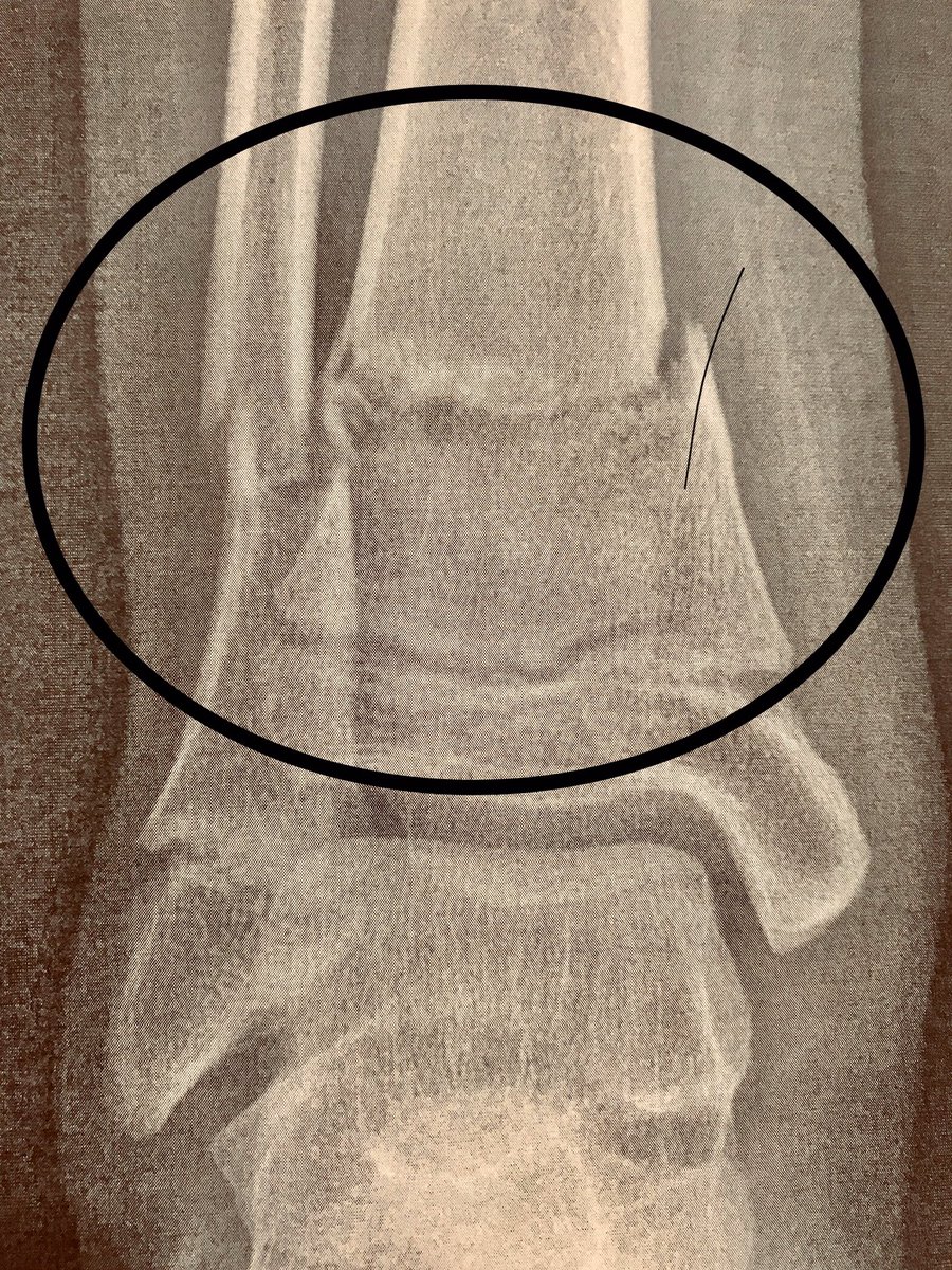 hockeylogic's tweet photo. Special thanks to Edina BB2 asst coach &amp; @TRIAOrthopedics surgeon Dr. Kirk Aadalen 😇for being there when our son broke his ankle at hockey practice last night. He settled things down and built a splint from our son’s shin pad (great idea hockey peeps). #grateful @edinahockey https://t.co/7tYuHEpidn
