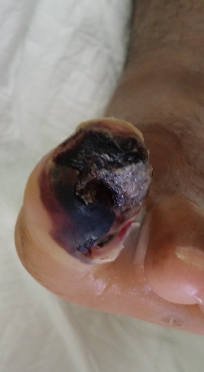 الغرغرينا في القدم السكري يمكن الحماية منه بالمتابعة الدورية مع الطبيب أو الممرض المختص وإتباع الإرشادات للحفاظ على القدم من أي جرح.