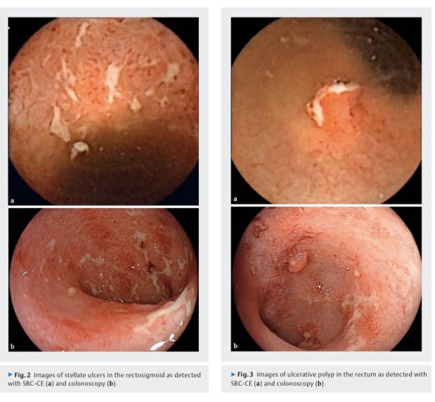 EIIPuertaHierro's tweet photo. So happy to see our collaborative work between @EIIPuertaHierro #Madrid and @ShaareZedekMed #Jerusalem about panenteric #capsulendoscopy #pillcam in #ulcerativecolitis #IBD
Will it ever play a role in #UC? https://t.co/BXnHqrZxMs
@geteccu @VirginiaMatall1 @SEEDendoscopia https://t.co/GMg6z9mkPq