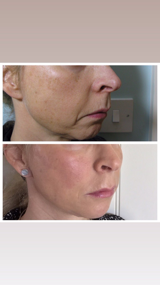 dr_ks_clinic's tweet photo. Jawline and chin rejuvenation. Delicate and pretty face restored. Happy patient, happy Dr. #masterinjector #aestheticdoctor #naturalenhancement #fillers #chester #wrexham #botox #lipfillers #jawline #beauty #filler #cheekfiller #cheekfillers #beforeandafter https://t.co/k6s0Fvny35