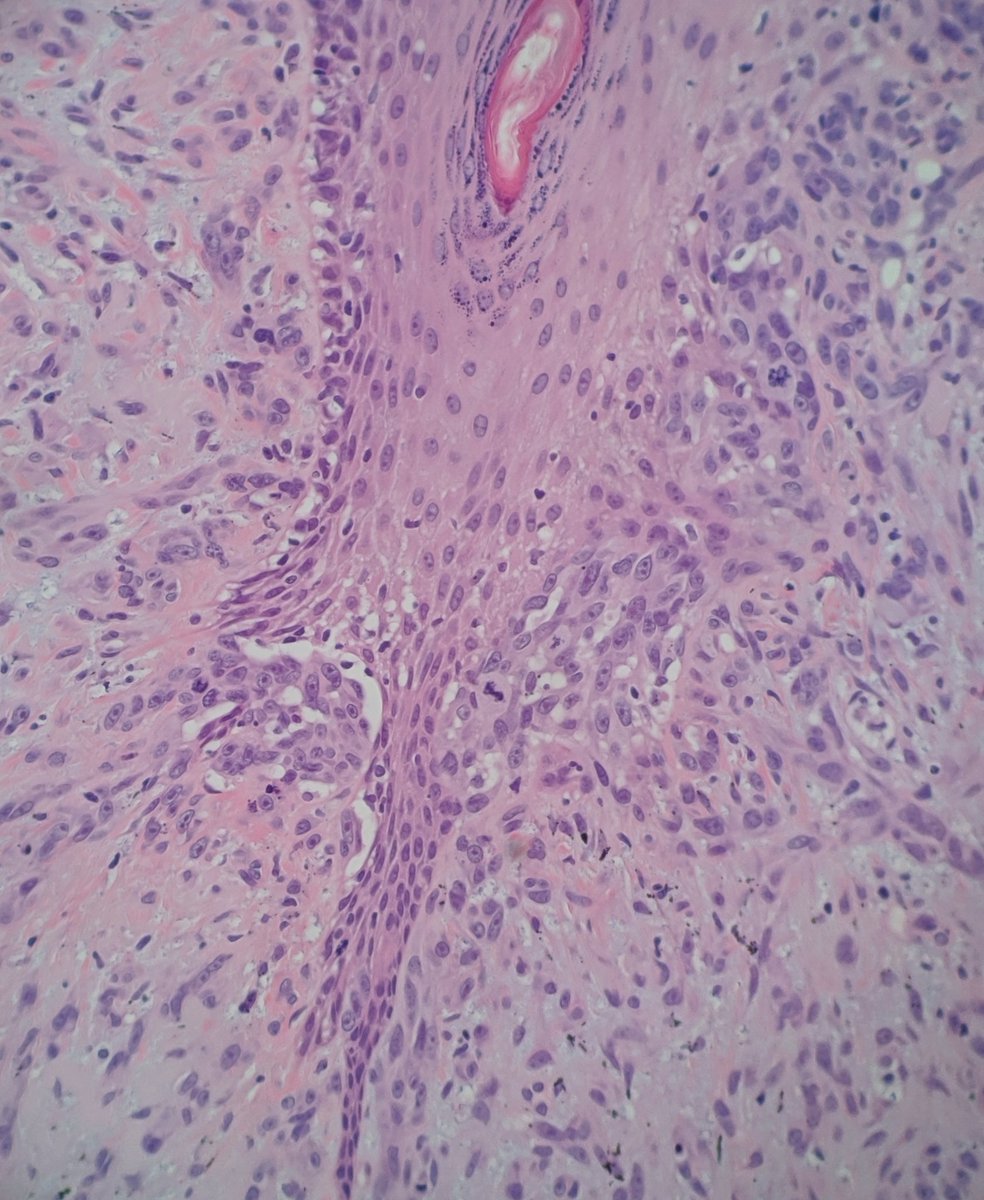 Cutaneous osteosarcoma? No, melanoma with osteoid formation. Most cases I have seen have been on the scalp, though some people see more mucosal or subungual cases. #dermpath #pathology #dermatology