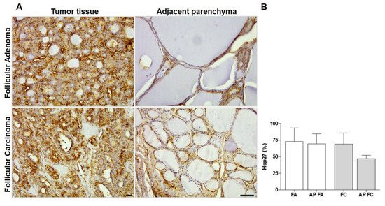 MDPIOpenAccess's tweet photo. Quantitative Immunomorphological Analysis of Heat Shock Proteins in Thyroid Follicular Adenoma and Carcinoma Tissues Reveals Their Potential for Differential Diagnosis and Points to a Role in... https://t.co/VsJdVaEMcD #Hsp27 #Hsp60 #Hsp70 #Hsp90 @Applsci https://t.co/LmyNLeisbu