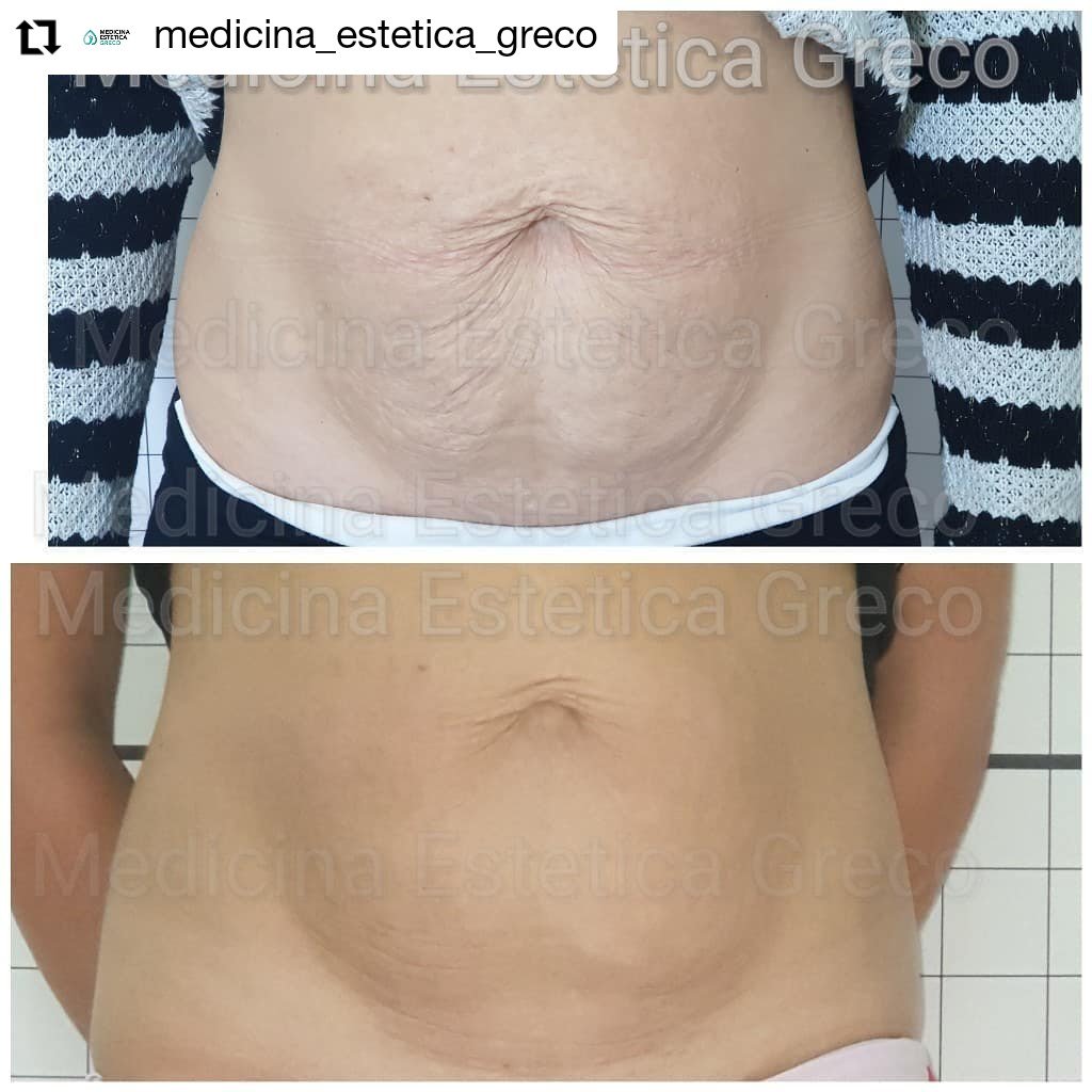 IrradiaSB's tweet photo. Regenera la piel de forma #noinvasiva con #Biodermogenesi. Un innovador #tratamiento que, como se puede ver en la imagen, mejora el aspecto de la zona tratada, tonificando y devolviendo la calidad a la #piel flácida y con #estrías.

https://t.co/RMC9SNrXyd https://t.co/YfrineIe68