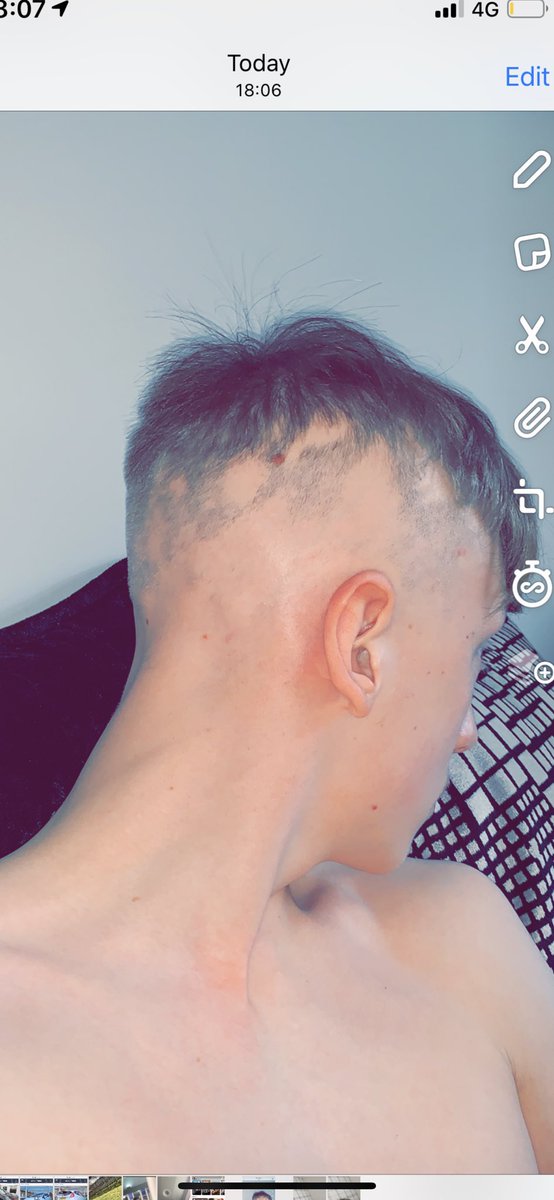 callum5anderson's tweet photo. #WorldMentalHealthDay #alopeciaawareness https://t.co/oRGU9WUQYP