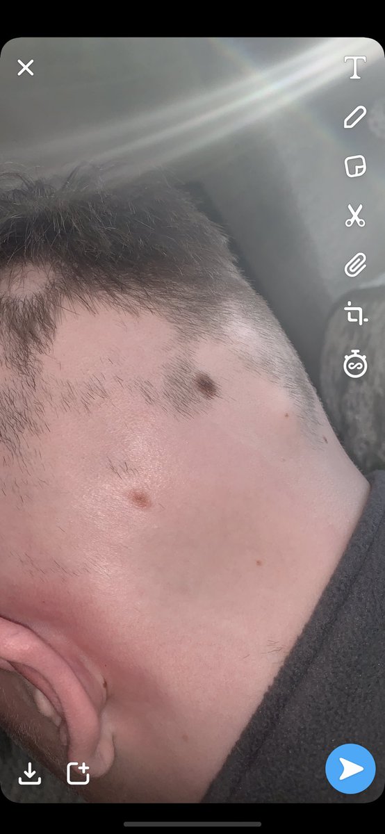callum5anderson's tweet photo. #WorldMentalHealthDay #alopeciaawareness https://t.co/oRGU9WUQYP