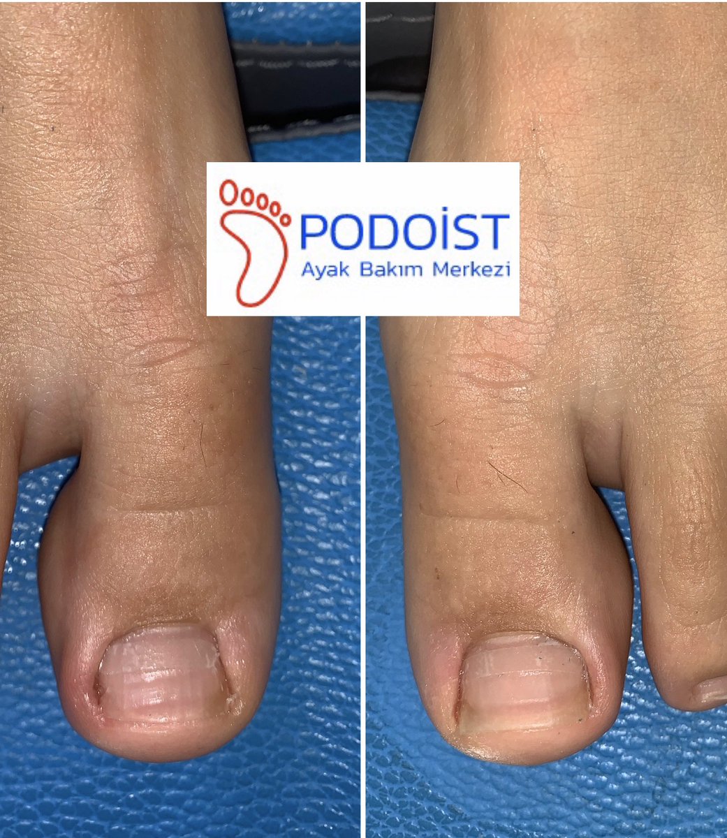 Batık tırnak tedavisinde Bant sistemi 

Detalı bilgi için #podoistayakbakımmerkezi

İletişim: 0530 181 6038
Web: podoist.com
Mail: podoist.asm@gmail.com