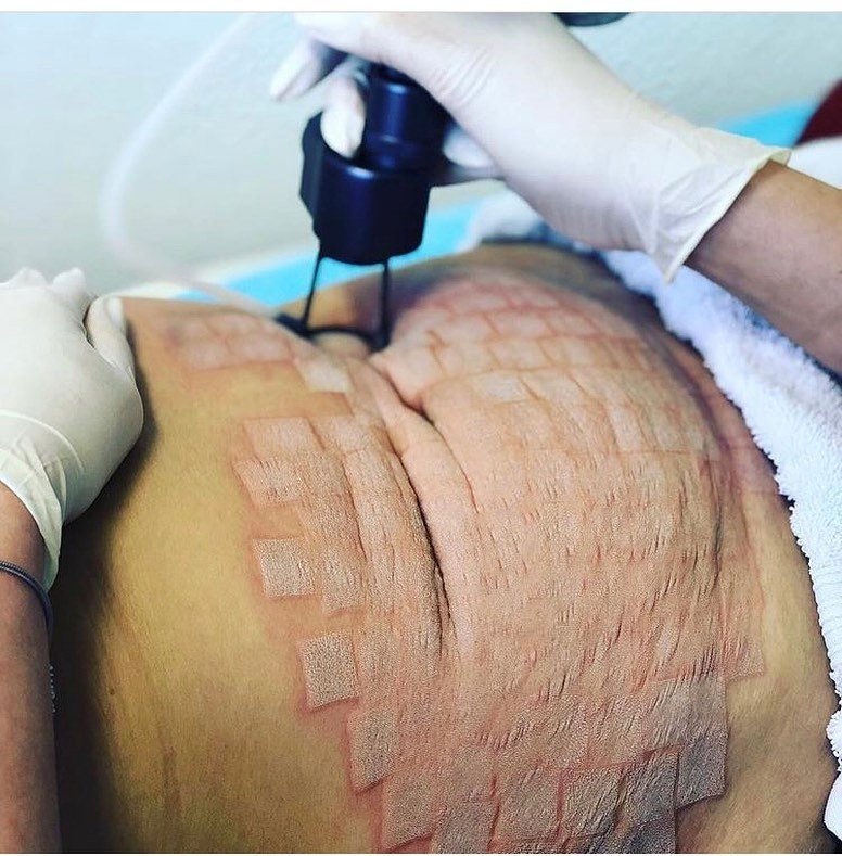 MaxMa87527171's tweet photo. #laserco2medicalfractional
#co2laserfractionalkorean
#co2fractionallasermetaltube
#fractionallaserco2
#co2lasertube
#co2lasermachineprice https://t.co/mNMKifrtAF
