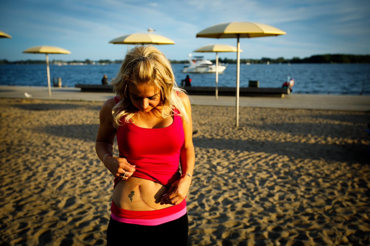 CityCristinaH's tweet image. They may appear to be some of the ugliest parts of me- but I’m learning to embrace the scars from my #kidneytransplant  &amp;amp; see them for what they are- a beautiful reminder of how lucky I am to be alive . @TrilliumGift #showyourscars #beadonor toronto.citynews.ca/2019/10/09/why…