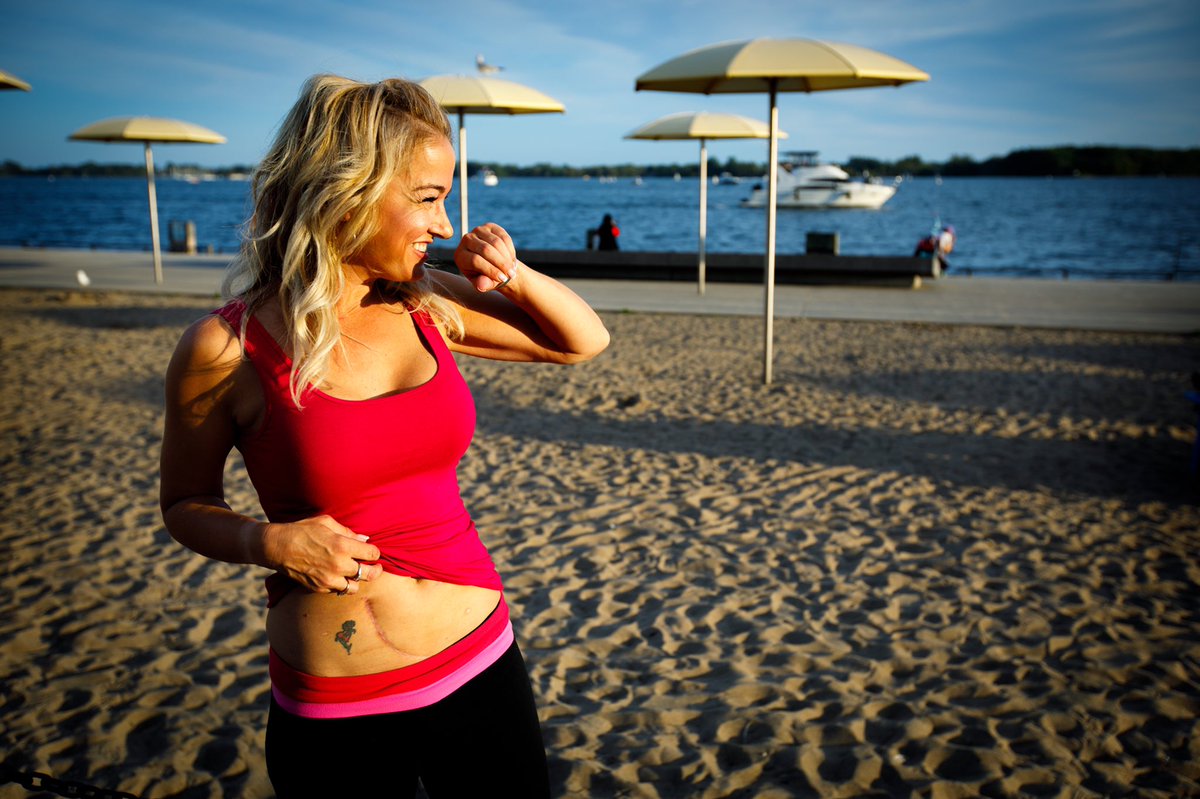 CityCristinaH's tweet image. They may appear to be some of the ugliest parts of me- but I’m learning to embrace the scars from my #kidneytransplant  &amp;amp; see them for what they are- a beautiful reminder of how lucky I am to be alive . @TrilliumGift #showyourscars #beadonor toronto.citynews.ca/2019/10/09/why…