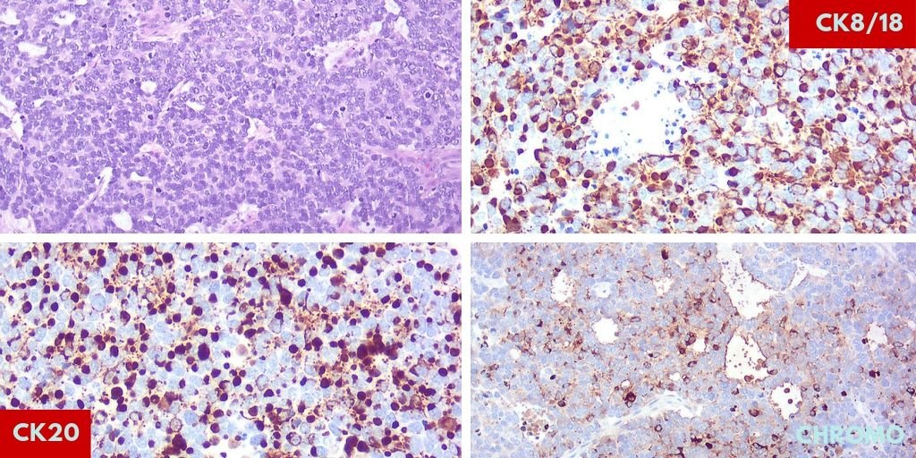Merkel Cell Carcinoma.
😍Beautiful dotlike pattern of Cks .
#Dermpath #Pathology