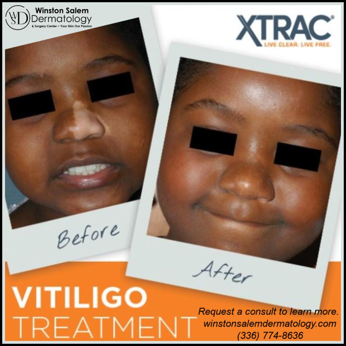 xtrac vitiligo treatment near me