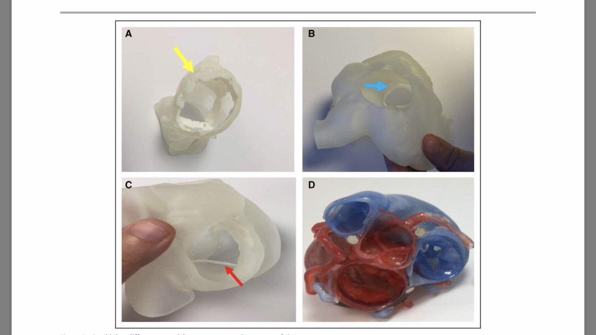 Check out our recently published review on cardiac #3Dprinting in @CircImaging. Great collaboration between @CleClinicMD and @HMethodistCV. Pleasure working with @SLittleMD @MarijaVukicev @tavrkapadia and Dr. Rodriguez. ahajournals.org/doi/pdf/10.116…