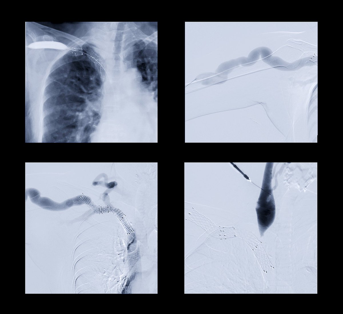 RBMAConnect's tweet image. Protect Future Reimbursement by Using Correct Specialty Designator for IR. Read more at bit.ly/10719Coding
#rbmablog #radiologycoding #ircoding #interventionalradiology #codingbootcamp