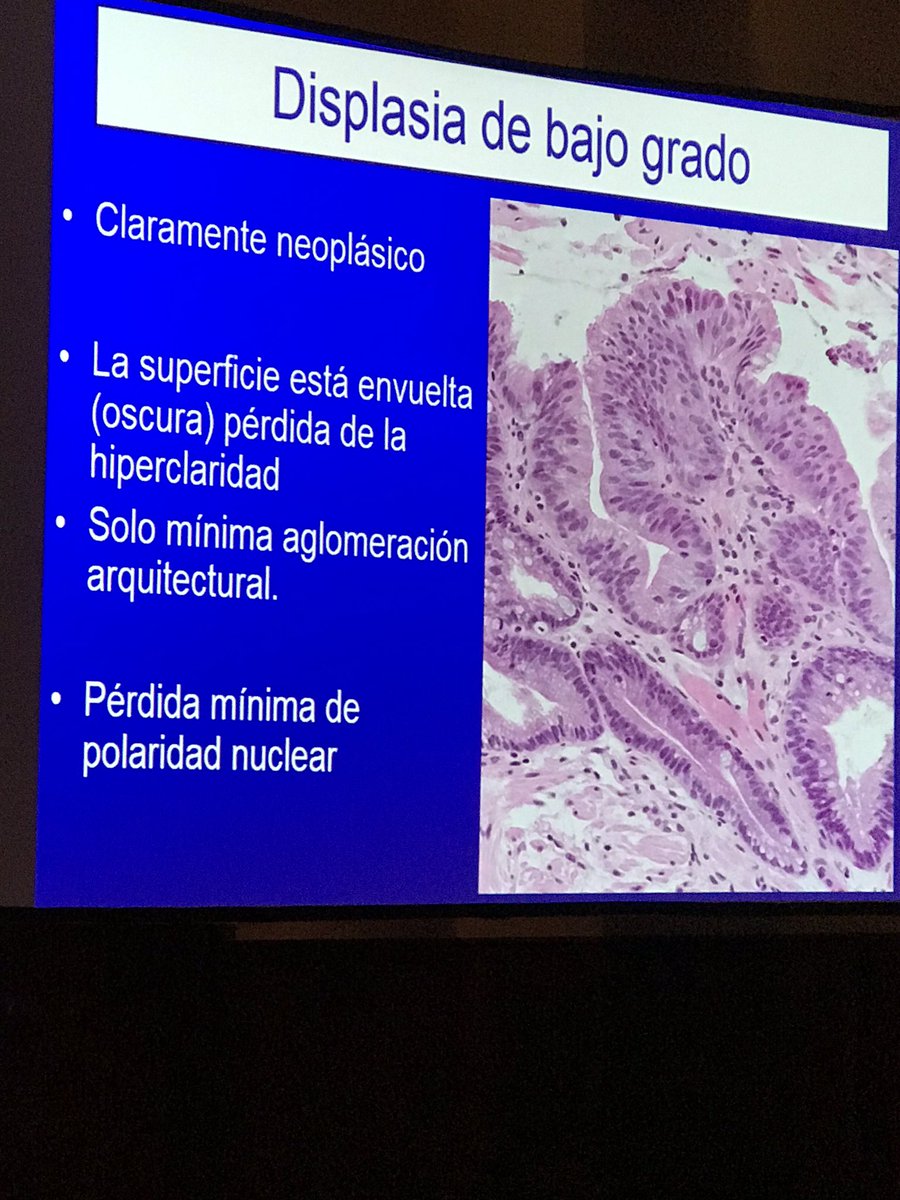 JCGarcesPath's tweet photo. #SLAP2019 Esófago de Barrett Displasia. Dra Ana Mariño https://t.co/79hhAHf0cY