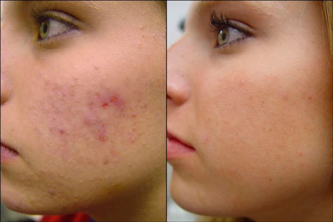 CanadaMedLaser's tweet photo. This gorgeous client underwent our ACNE PROGRAM and got these amazing results. DM us to know more about the details of this program! https://t.co/h5VBK00Osa