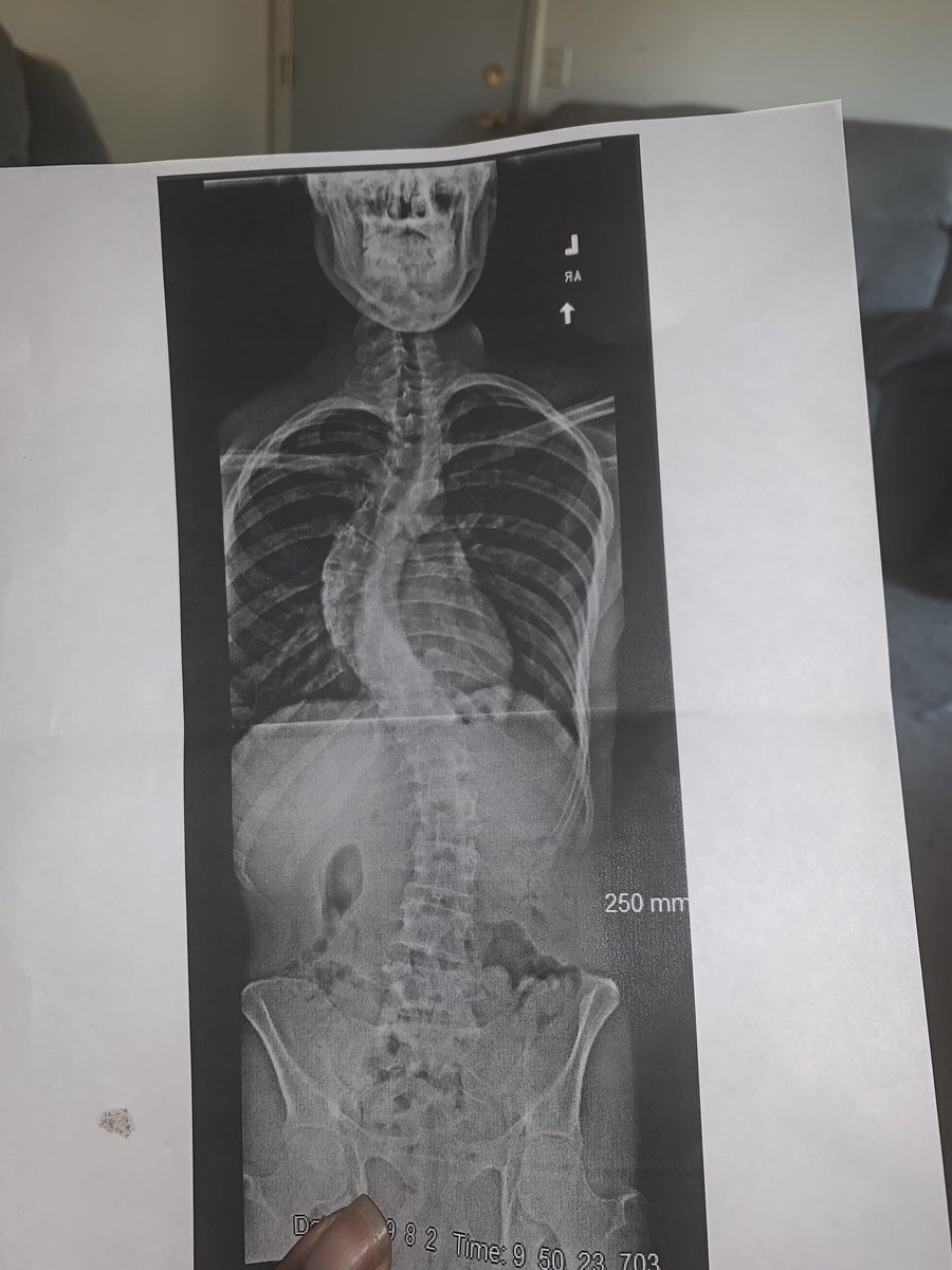 Futuremoney21's tweet photo. My spine before surgery on the 17th https://t.co/mC1cKZwimD