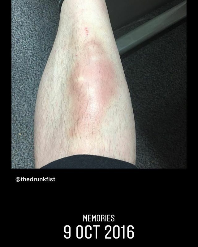 drunkyfist's tweet photo. Wow 3 years ago. Fingers crossed I’ll soon be able to get back training again. #boxing #muaythai #muaythaitrainjng #shinconditioning #padwork #kettlebells #backtofitness #fatoldmantho https://t.co/g4SDxEYjaR https://t.co/BEbDQHMNHt