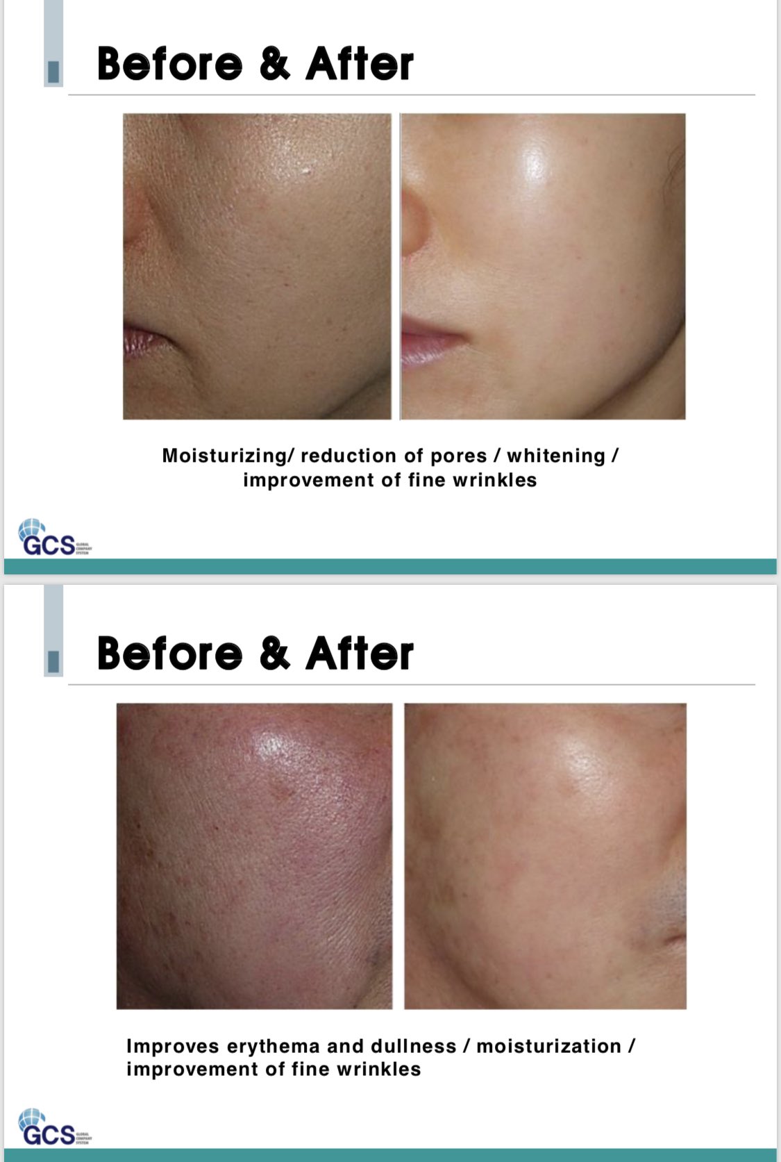 美容皮膚科 Ubclinic銀座 アップビュートクリニックでは 水光注射 プラズマシャワー導入液 Co2後の塗布薬剤として Mtp36 という薬剤を使用します 日本ではまだ知名度がないですが 成分として優れており 俗に言うシャネル注射の後発品となっており