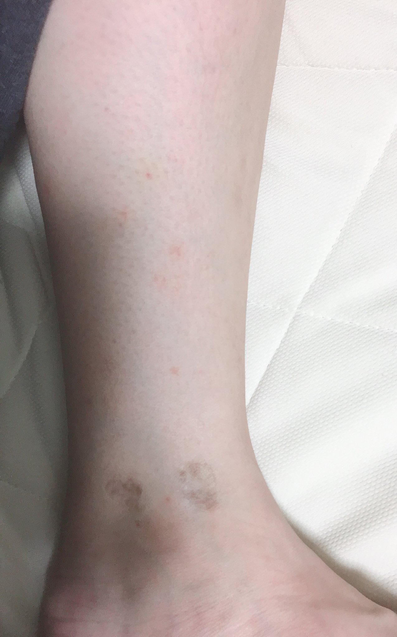 リベド血管炎 の 初期症状 赤斑点 出てきたなぁ リベドの傷痕自体は薄くなってきたけど この斑点かゆいんだよなぁ でもかくと 陥没 するからかかない 色素沈着 しつつもうすくなってくれて嬉しい 難病 なのに 難病指定 されてない