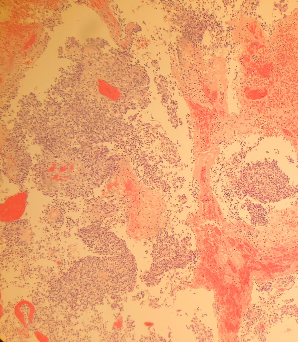 doctorazua's tweet photo. #pathologist I need help: 10 months female; tumor in posterior fossa. IHQ: ki67 30%, EMA&CD99 +; FGAP&OLIG2 +focal; B-Catenin -; Keratin + focal; INI1 -; Ependymoma Vs Atipic Rabdoid Tumor ๐คทโโ๏ธ https://t.co/t9mQiwIHZD
