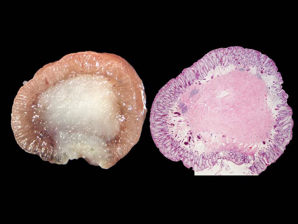 Macro/Micro correlation of a Gastric leiomyoma, a rare benign mesenchymal tumor
(Desmin+, SMA+, CD34-, CD117-, DOG1-) Provided by my #GIpath colleague Isabel Amengual  #grosspath
