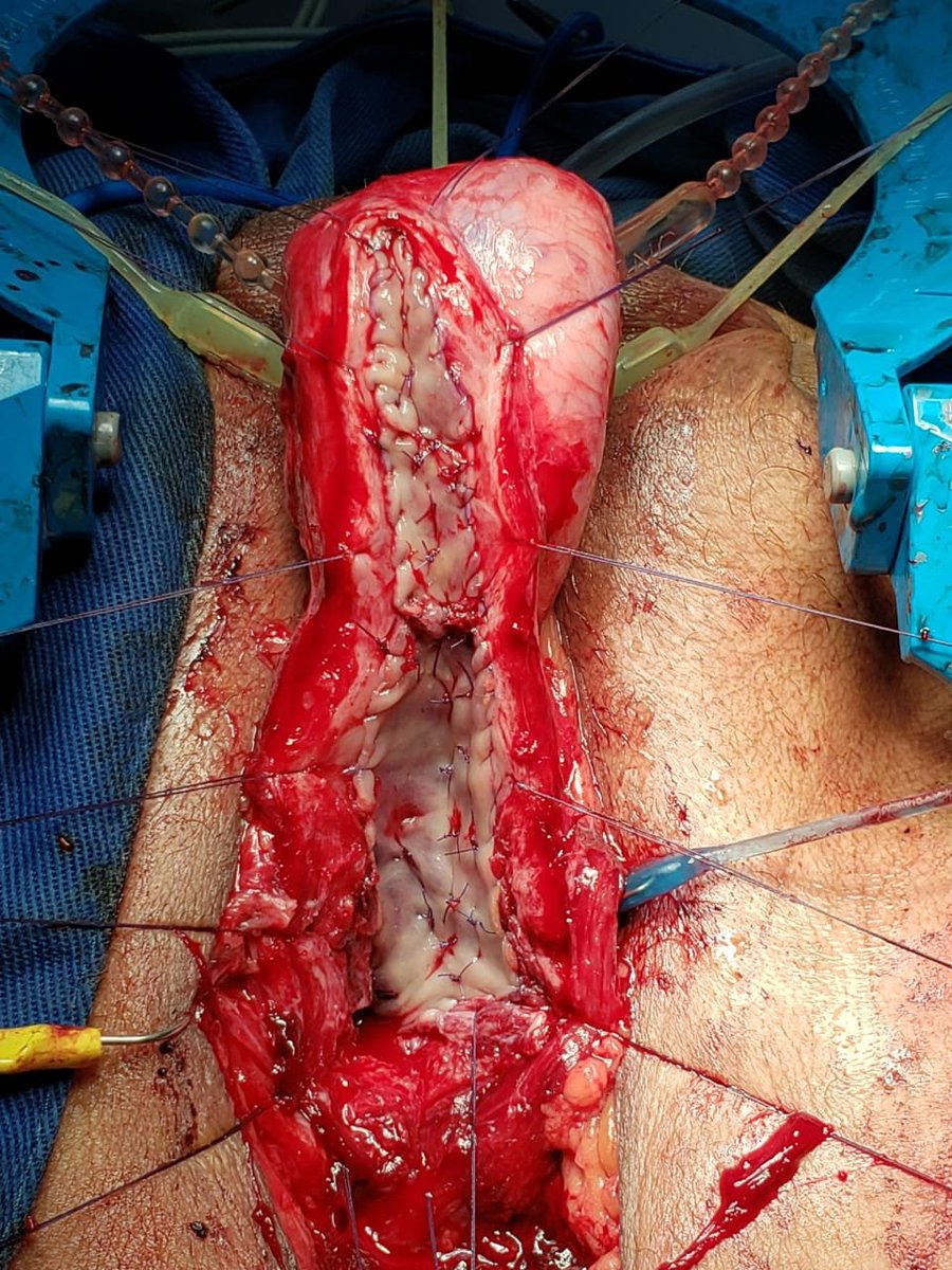 Kulkarni urethroplasty with dorsal inlay buccal graft for a panurethral anterior stricture
Drs. Jaime Pérez, Camila Moreno, Luis Gabriel Villarraga