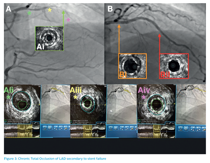 radcliffeCARDIO's tweet photo. Stent failure remains a significant challenge in the treatment of #CAD and is a recurring burden within the complex #PCI setting.
In our July #RCwebinar @PhilipsHealth @DrPeterOKane shared his tips & tricks on navigating through this. Watch for free ➡️ https://t.co/k04Wzl4v5D https://t.co/ILpqQVbG55