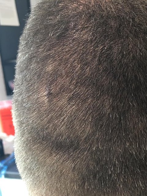 ClinicScalp's tweet image. 1st session of smp to cover a scar
#Scalpmicropigmentation #smp #scalppigmentation #nomorebaldness  #womenhairloss #menshairloss #baldheads