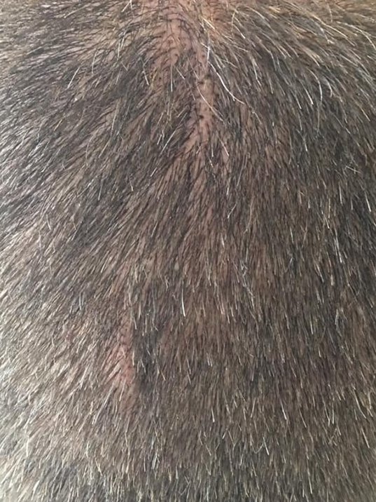 ClinicScalp's tweet image. 1st session of smp to cover a scar
#Scalpmicropigmentation #smp #scalppigmentation #nomorebaldness  #womenhairloss #menshairloss #baldheads