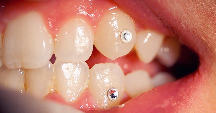 Oldhookdental's tweet photo. Tooth jewels, small rhinestones are bonded to the tooth, just like a dental bracket. No drilling, no shots: It is a quick and painless process that can also be removed with ease. It is completely reversible! 

Give us a call and have your gem done by a professional! 😁 https://t.co/iwfAZyVli2