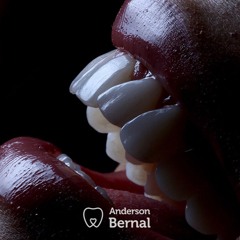 #casosdomeudia Caso clássico de #lentesdecontatodental, começou de manhã, terminou no final da tarde, no mesmo dia! Foto artística p/ mostrar os detalhes que conseguimos nos sistemas digitais by <a href="/DentsplySirona/">Dentsply Sirona</a> <a href="/DSCEREC/">DentsplySironaCEREC</a> 
Agendamentos: (11) 95425-6486