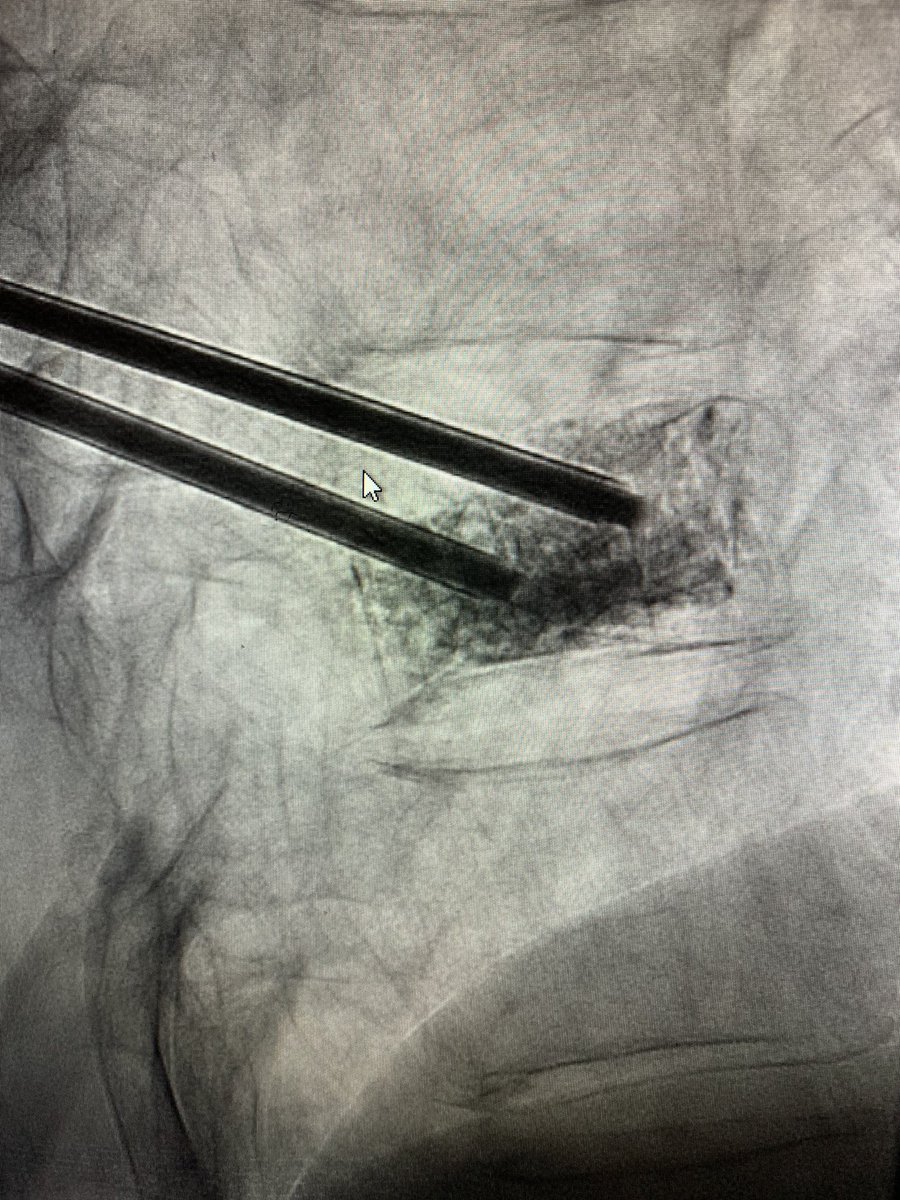 DigitalAngio's tweet photo. Vertebroplasty for a fractured T9. Used Cortoss to cement fractured site. Great day to be a med student in the IR suite! #MSKinterventions @JeffersonRads @SIRspecialists @SIRRFS https://t.co/1h23laq2IY