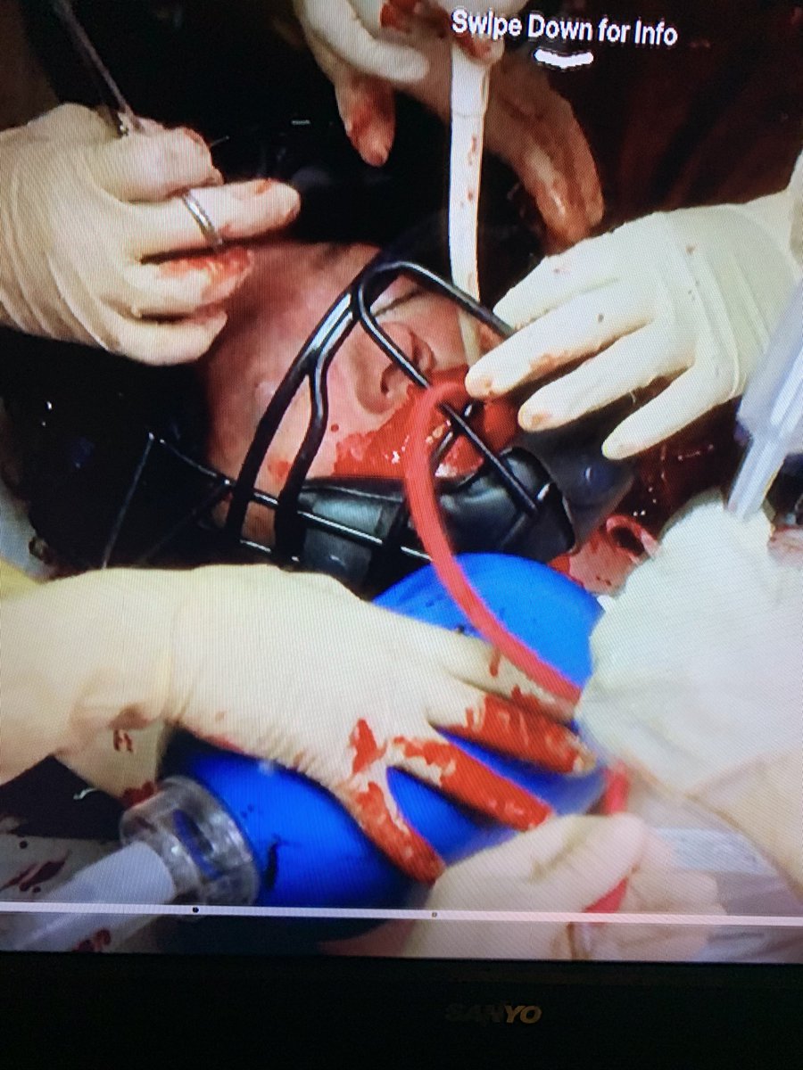 Alright I’m gonna need one of y’all to tell me why they put an honest to god catcher’s mask on this woman with bleeding esophageal varices