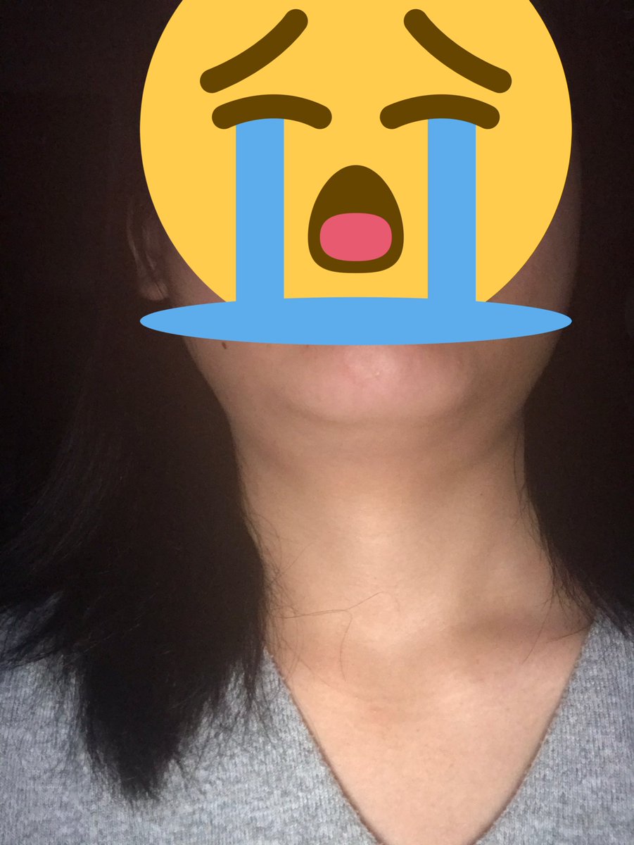 黎 過食嘔吐 拒食の悪化中 今日ふと鏡みたら 唾液腺がパンパンで エラ張り顔で元から顔がでかいのにその倍にもなってるんじゃないかってくらいで首も太いし 筋トレも出来なくなってしまったから脚も太いしおしりもデカいしでとても辛い とてもブス