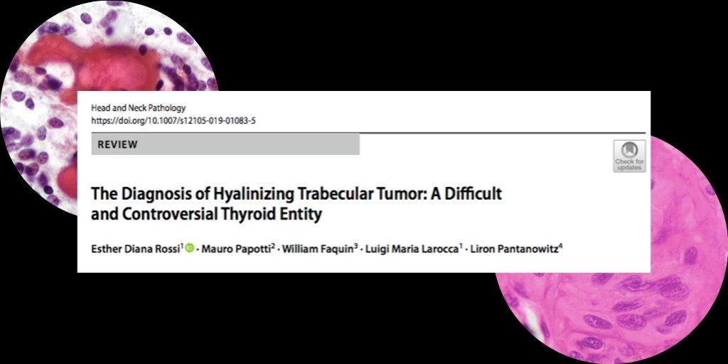 ⚠️Tips and Pitfall alerts in the evaluation of Hyalinizing Trabecular Tumor. It is worth checking ! ⚠️
☑️link.springer.com/article/10.100…
#HNPJ #Entpath #pathology <a href="/HeadandNeckPath/">Lester Thompson</a> <a href="/HeadNeckPathol/">Head Neck Pathol</a> <a href="/pembeoltulu/">Pembe Oltulu, MD</a> <a href="/NejibY/">Nejib Ben Yahia, MD</a>
