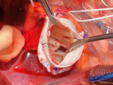Aortic Regurgitation: Surgical Repair Options bit.ly/320Fmoh #tssmn #Cardiac #Aortic #Valve <a href="/AKappetein/">Attila Kappetein</a> <a href="/drnikkistamp/">Dr Nikki Stamp FRACS</a>
