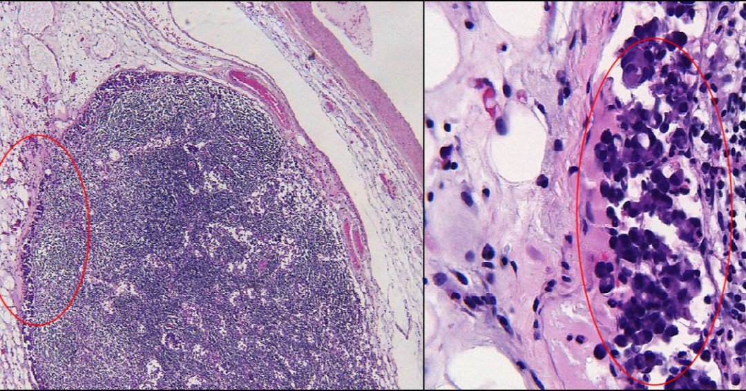 TexPathol's tweet photo. 73 yo F with ischemic bowel. Sampling of lymph nodes is important! This lymph node (left) shows microscopic foci of subcapsular metastatic gastric adenocarcinoma (left). This incidental finding on sampling of lymph nodes led to a work-up that detected gastric cancer. https://t.co/Kx3uzfABSG