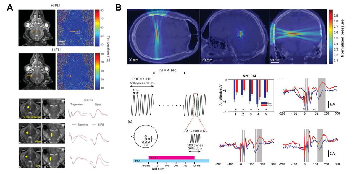 Brainbox_Neuro's tweet photo. Did you know that tFUS enables non-invasive brain stimulation with unprecedented spatial resolution and cortical depth? Evidenced by stimulation of the VPL of the human thalamus
#whatstheneurofus #neurofus #focusedultrasound #neuroscience #brainstimulation https://t.co/AzPGcQM2iF