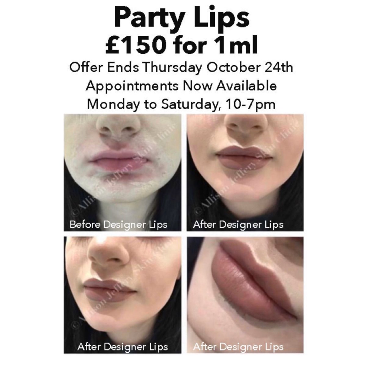 AllisonJeffery_'s tweet image. A few days left of Designer Lips ™️ at £150 for 1ml. Offer ends next week . Prices &amp;amp; Lip Gallery On Website 
Please text or phone 07376 486823 / 07989 355935 to book! Appts Monday to Saturdays 
allisonjeffery.com #dermalfillers #skinclinic #brighton #lipfillers