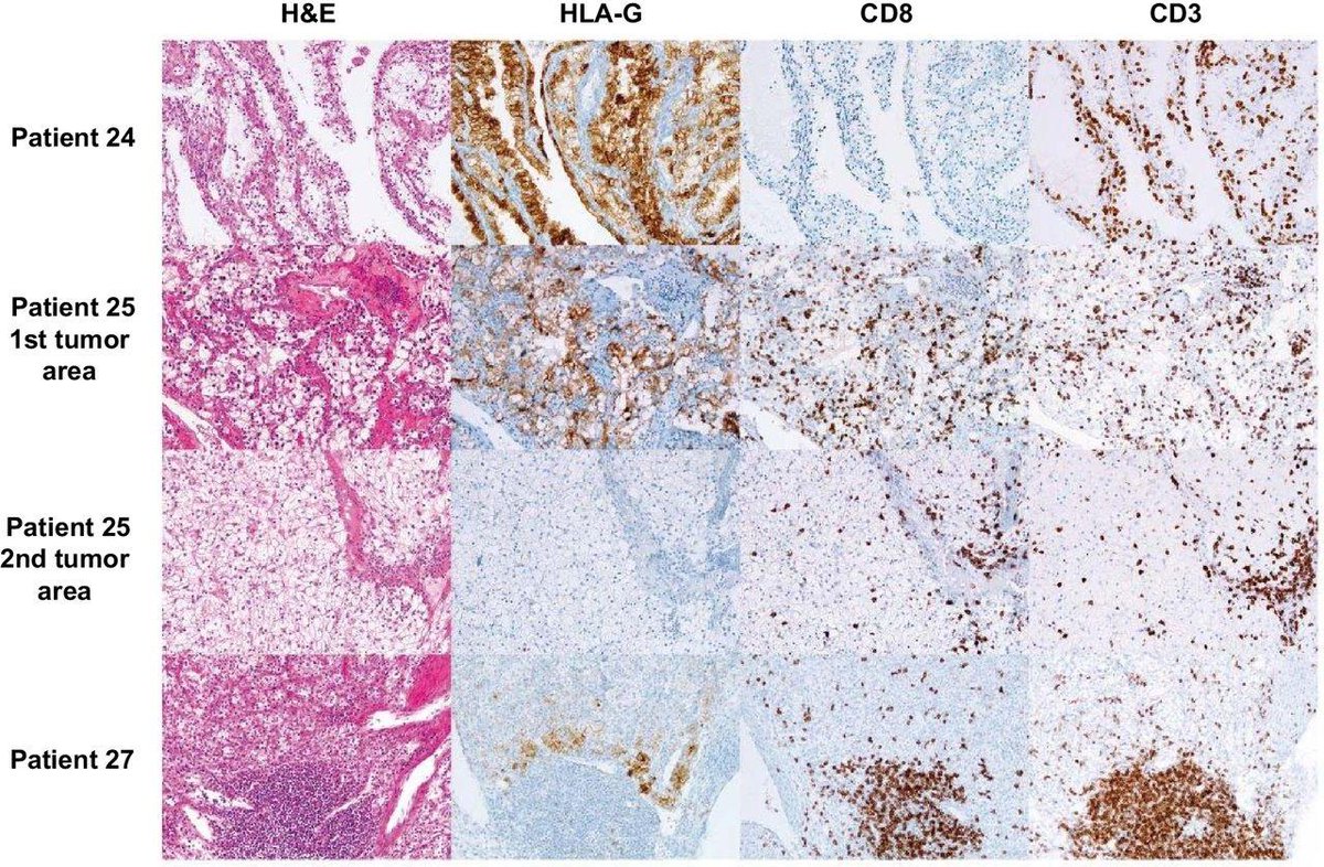 CIR_AACR's tweet photo. Read about an effector T-cell subset lacking #PD1 expression that has potential as a therapeutic target. #ILT2 #RenalCellCarcinoma
#CheckpointBlockade https://t.co/Hsclzlw5pJ https://t.co/latGt85PQs