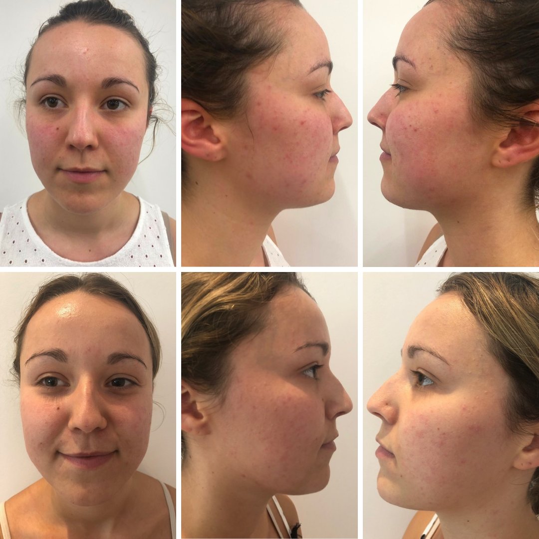 Ellie has had 6 of her 8 3D-HydrO2 Facial treatments, targetting congestion, but here are her results from just 3 of those treatments!

This treatment course included the hydro peel, deep cleanse, hydration, oxy spray and cold plate technologies to achieve these results.