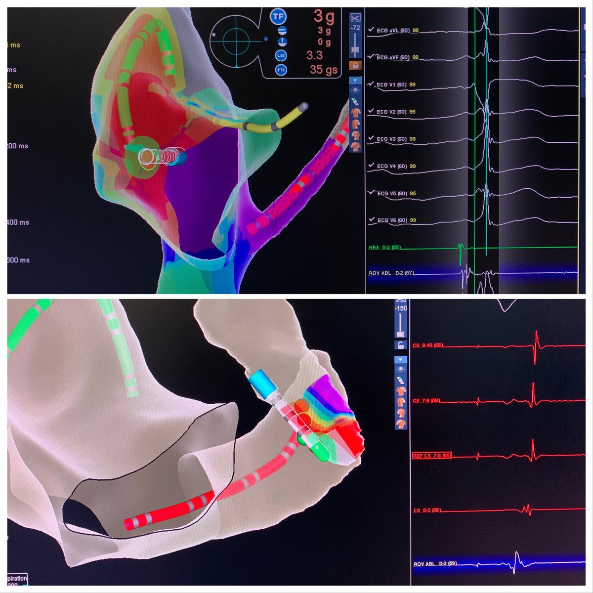 It’s Pathway Friday. 

Right lateral (#TactiCathSE helpful to assess contact) and left posterior(#viewmate). Great signals and pathway potentials on both. #nofluoro #vaheartbeat ⁦⁦<a href="/AbbottRichmond/">Abbott Richmond</a>⁩ ⁦⁦@ZilinskasAshley⁩