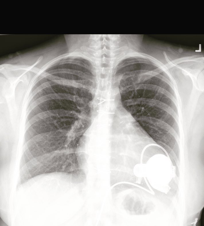 #flashbackfriday to the time I had no heartbeat......you would not believe the faces I would get when I would tell them I had no pulse😂 This device saved my life and literally was a part of me for over two years. God and modern medicine sure are amazing! #lvad