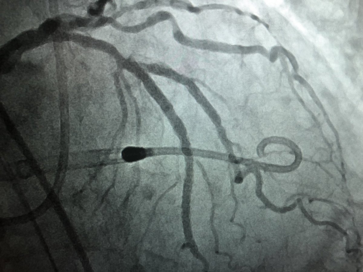 DrAmirKaki's tweet image. 85 yo active farmer with severe three vessel calcific disease and non dilateable lesions successfully treated with Impella supported OCT guided orbital atherectomy.  #completerevasc